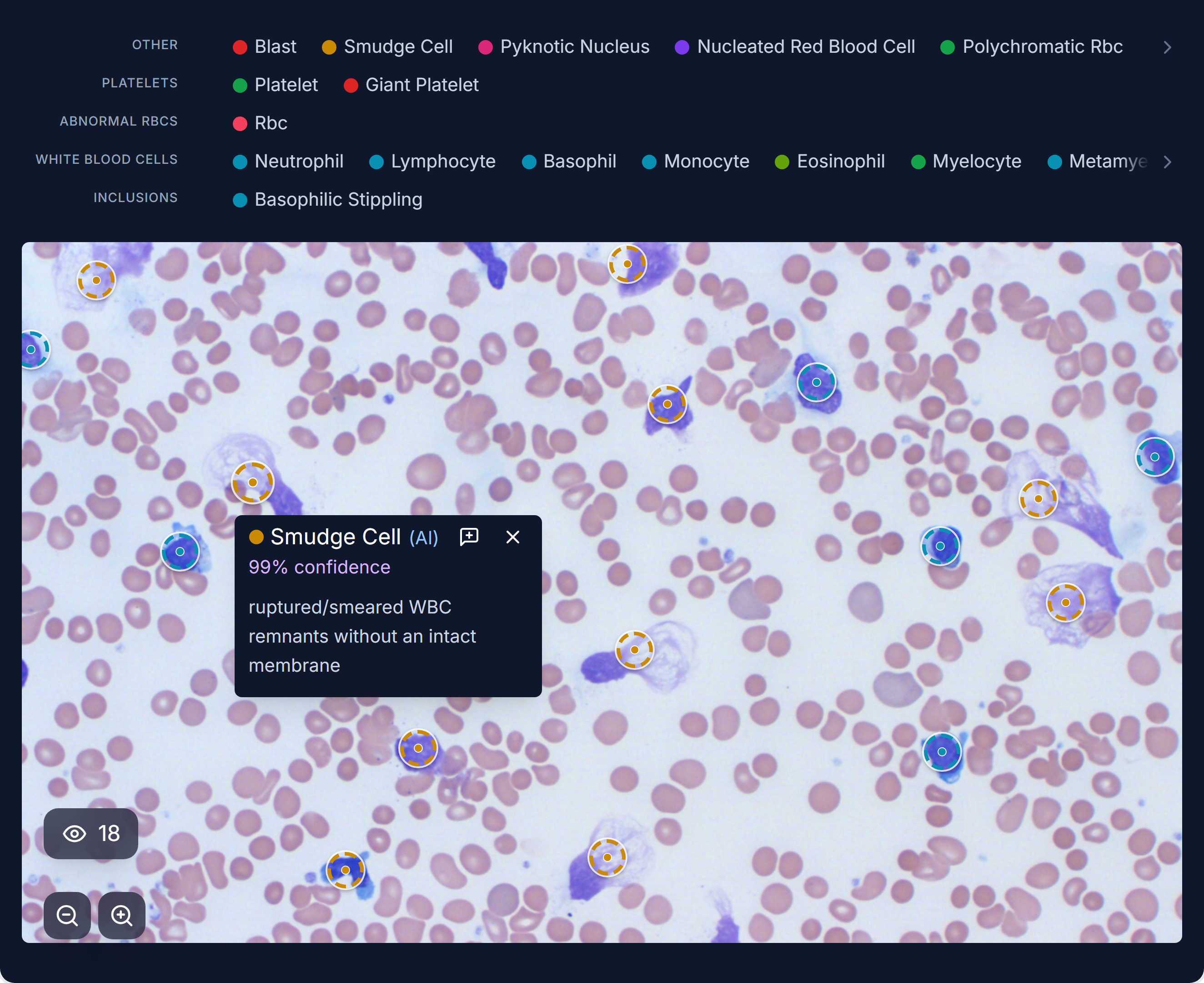 Peripheral blood smear, mature lymphocytes and smudge cells marked, each with a confidence score
